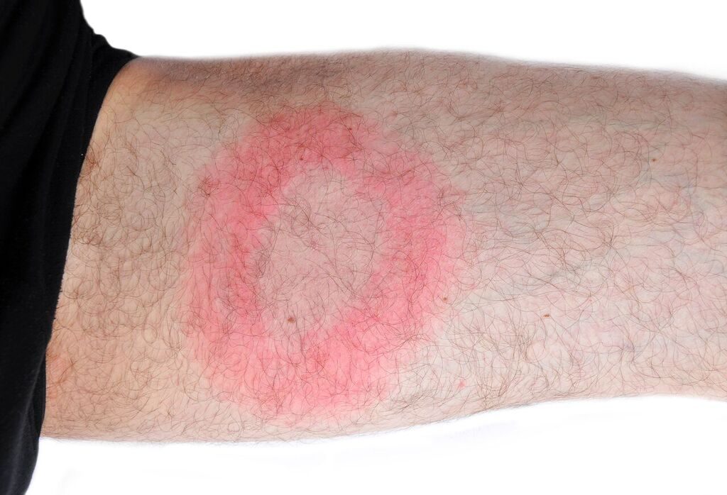 Erythema migrans (EM) rash prevelant in approximately 70% of Lyme Disease cases.